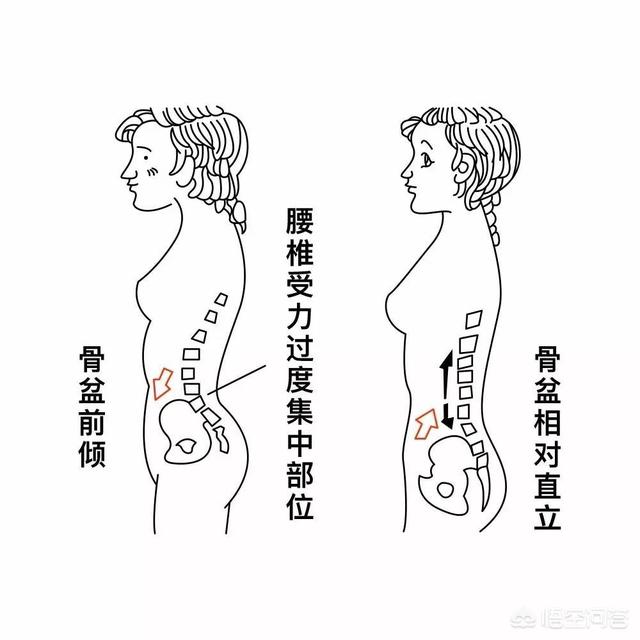 骨盆前倾怎么办？怎样纠正？做拉伸运动可以吗？