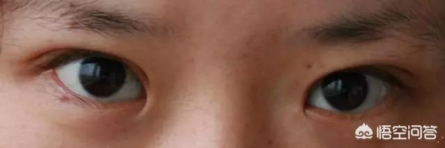 开眼角对比图:割双眼皮不开眼角是一种什么体验？