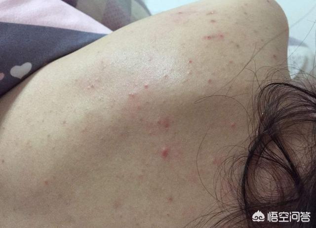 头条问答 - 后背螨虫如何自测?(7个回答)