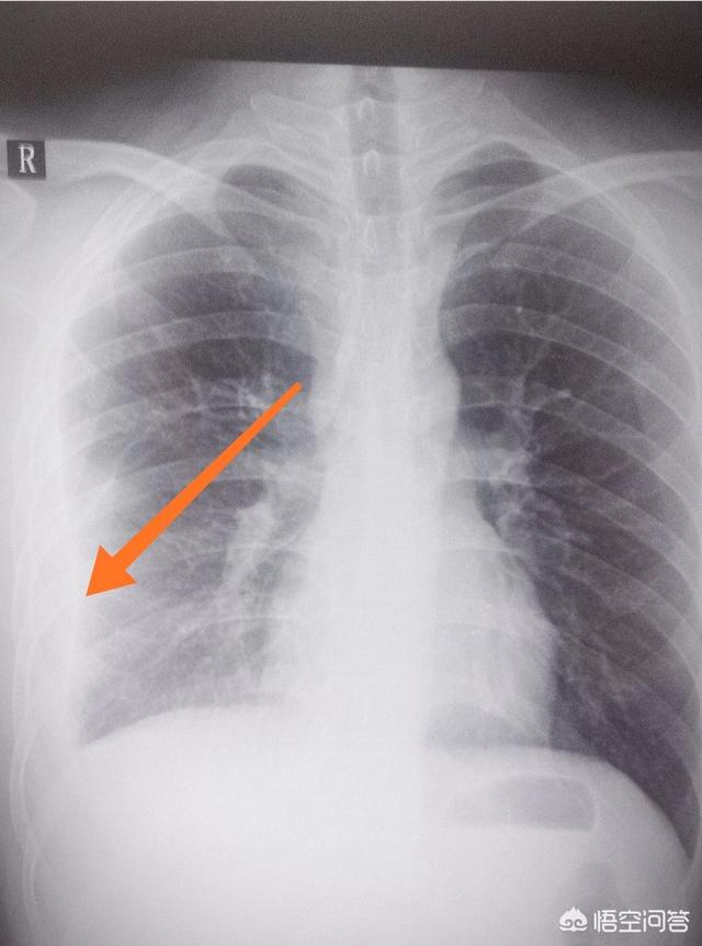 老年人胸腔积液病因有哪些，请问肺结核会导致胸腔积液吗？