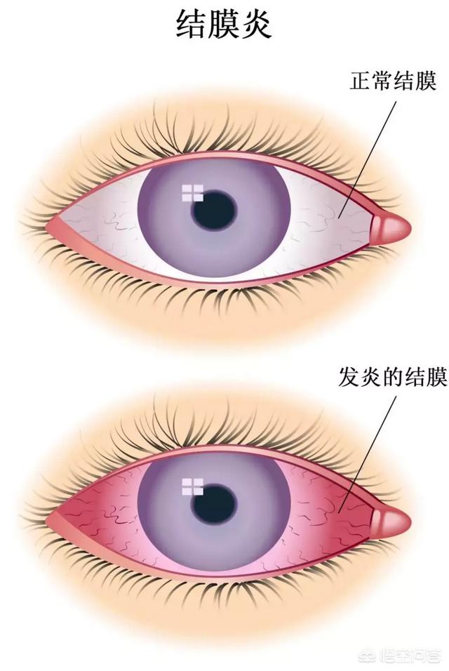 结膜炎传染吗:干眼症和结膜炎的区别是什么？