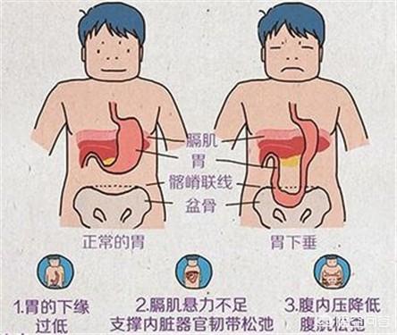 头条问答 - 如何判断自己是否胃下垂,胃下垂的症状和治疗方法有哪些?