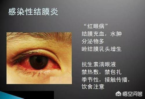 怎么可能得红眼病：怎么确定得红眼病