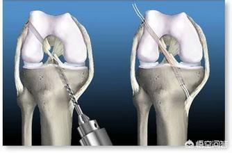 前交叉韧带断裂术后锻炼:前交叉韧带重建为啥整条腿肌肉都是紧张的？