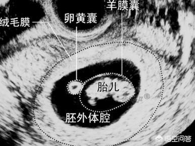 头条问答 怀孕四十天孕囊有多大 需注意什么 学而时习之育儿的回答 0赞