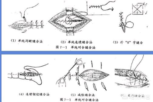 顺产撕裂缝针需要拆线吗 菁妈育儿的回答 头条问答