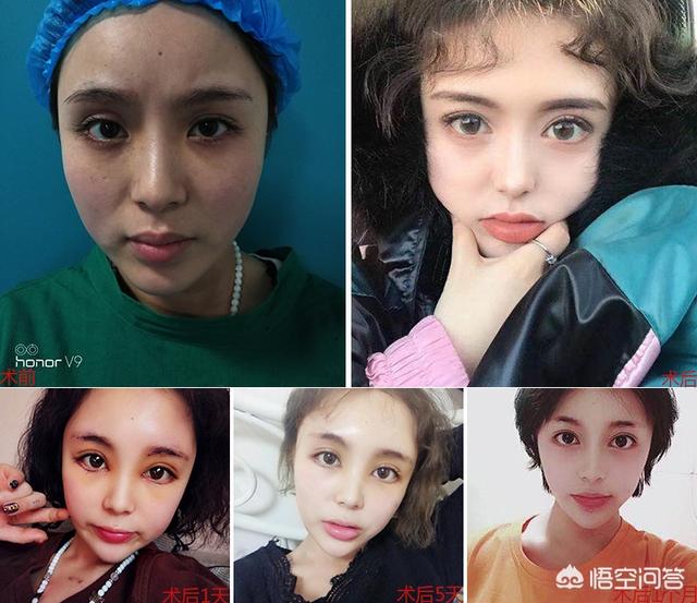 下睑下至导致睑外翻:下眼睑下至术哪些人群需要做？