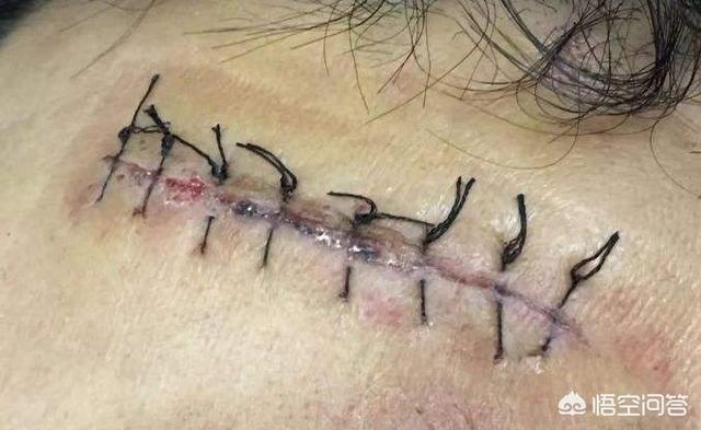 头条问答 - 女性剖腹产后,如何减少术后疤痕避免刀口增生呢?