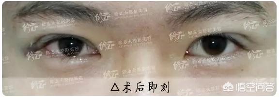 古巨基割双眼皮:对于男生割双眼皮你们怎么看