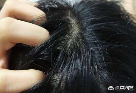 毛囊虫:脸上粉刺能挤出黄色颗粒是毛囊虫吗？