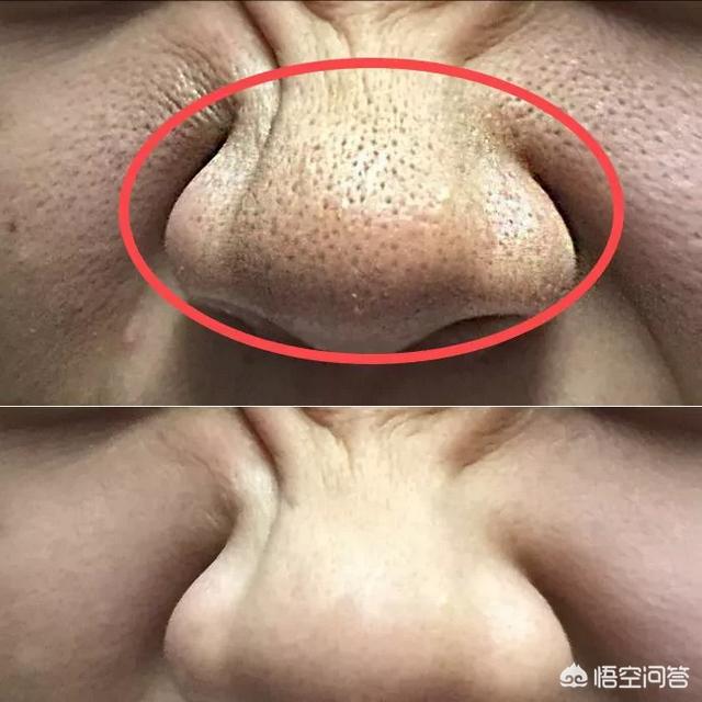 根治毛孔粗大,硫磺皂洗脸对毛孔粗大有用吗？