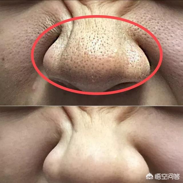 怎么清理毛孔(怎么清理毛孔里的油脂)