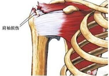脱臼,肩膀老响感觉脱臼了，怎么回事？