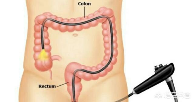 肚疼拉肚子便血是怎么回事:从左侧腹痛到便血到拉肚子有二年了会是肠癌吗？