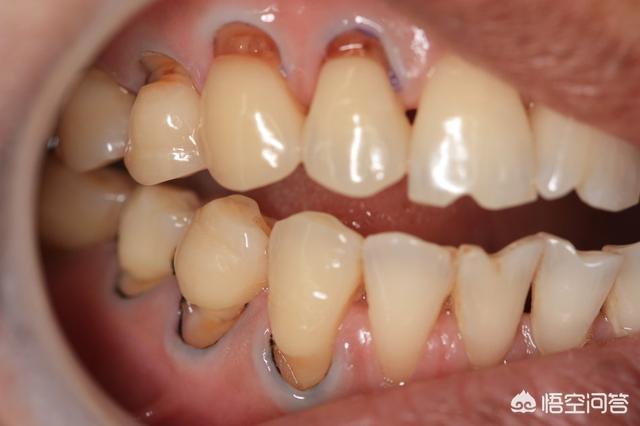 头条问答 - 什么情况需要补牙?(5个回答)