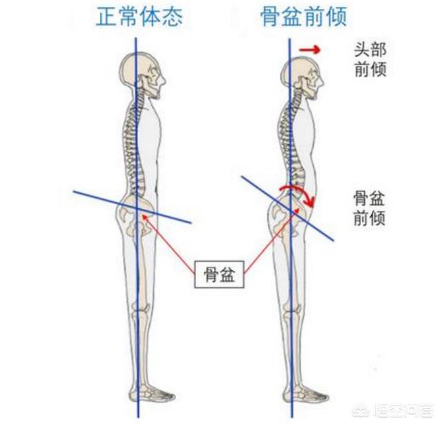 骨盆前倾能靠墙站纠正吗？