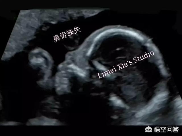头条问答 四维检查鼻骨未显示是什么原因 8个回答