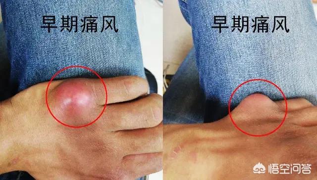 痛风疼痛严重,该怎样治疗?-终于实宪