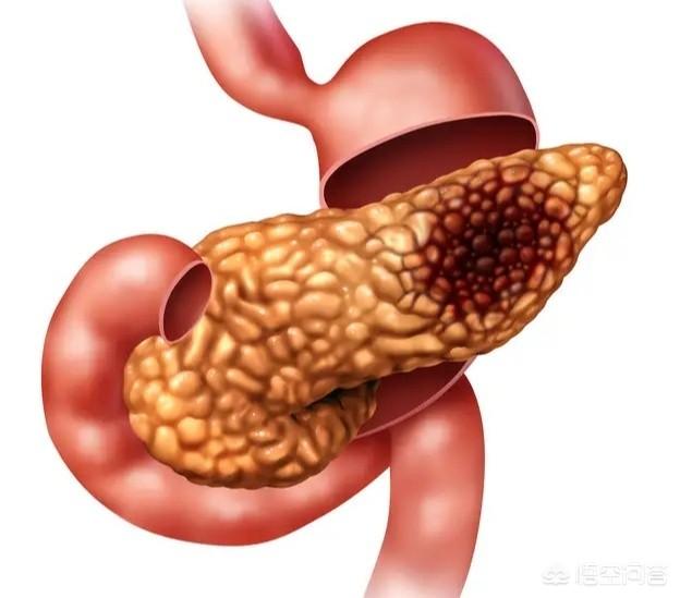 急性胰腺炎的治疗:急性重症胰腺炎能恢复吗？