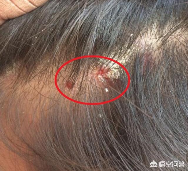 头皮长的红疙瘩就是发炎的痘痘,长在头皮上称之为毛囊炎