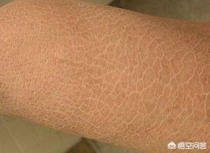 夏季皮肤问题图片:夏天如何改善“鸡皮肤”和“蛇皮肤”？