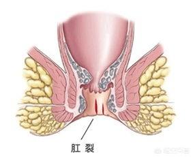 拉血是怎么原因(泻血是什么原因)