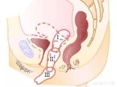 什么是子宫脱垂，准备生二胎，检查的时候发现子宫脱垂，还能生吗你怎么看