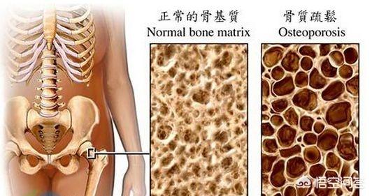甲状腺机能减退与骨质疏松:艾滋病病人为什么会出现骨质疏松？