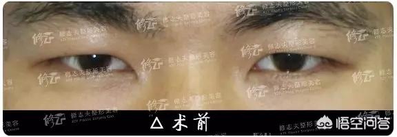 古巨基割双眼皮:对于男生割双眼皮你们怎么看