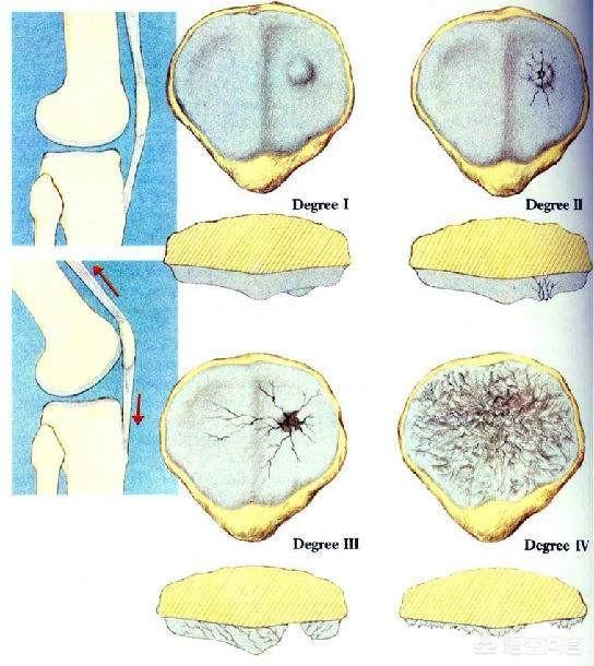 膝盖软骨磨损和风湿什么区别:风湿关节炎引起的软骨磨损 膝盖退行性病变是什么意思？
