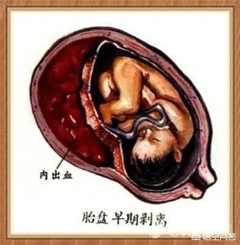 肩难产:肩难产的七步处理方法 生小孩是剖腹产好还是顺产好？为甚么？