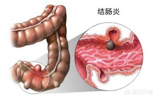 急性肠炎的症状:急性肠炎的症状表现有哪些 慢性肠炎和急性肠炎有什么区别？