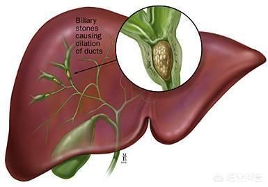 胆总管结石的症状是什么:胆结石病会引起上不来气，头晕的症状吗？