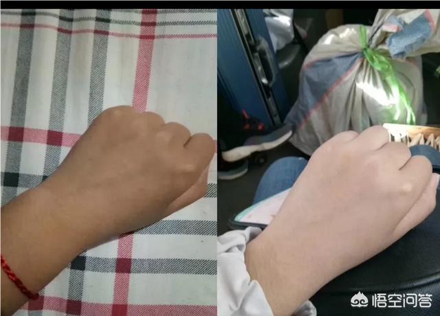 怎么美白？皮肤一见阳光就变黑？