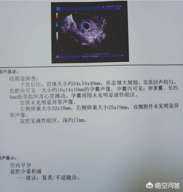 怀孕多久能做b超:怀孕44天了能做B超吗？
