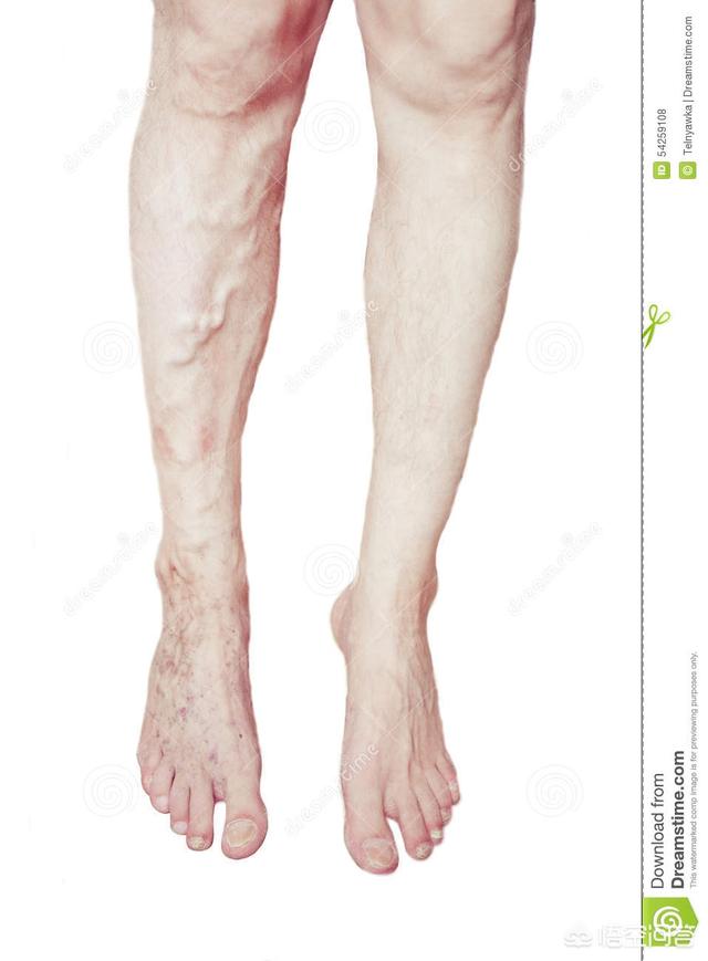 大腿根部有像蚯蚓一样的血管,青紫色弯弯曲曲的,盘根错节鼓出来,到底