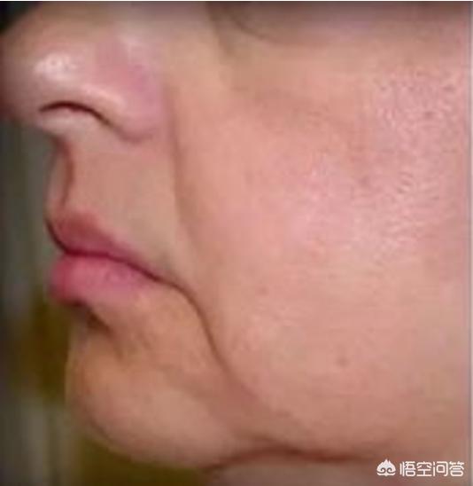 怎样淡化法令纹(怎样淡化法令纹学生党)