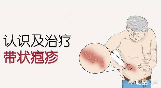 环箍蛇:箍腰蛇这种病是什么特点？