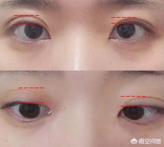 古巨基割双眼皮:对于男生割双眼皮你们怎么看