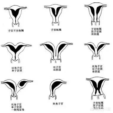 头条问答 - 怀孕后子宫纵隔撑开的可能性大吗?该如何避免?(4个回答)