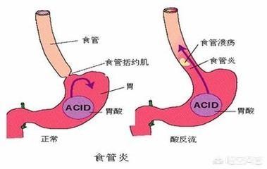 口水多是怎么回事:反流性食管炎会引起口水多吗？