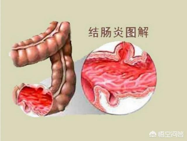 得了真菌性肠炎怎么办:痢疾性肠炎怎么办 患了肠炎可以吃什么消炎药？