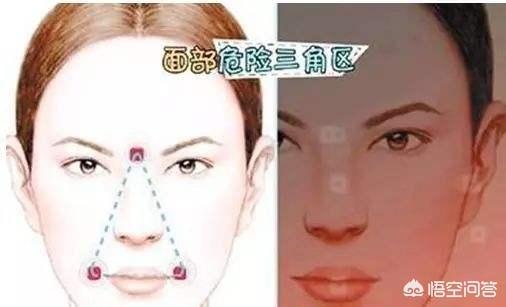 面部危险三角区:你知道面部三角区的痘痘为什么不能乱挤吗