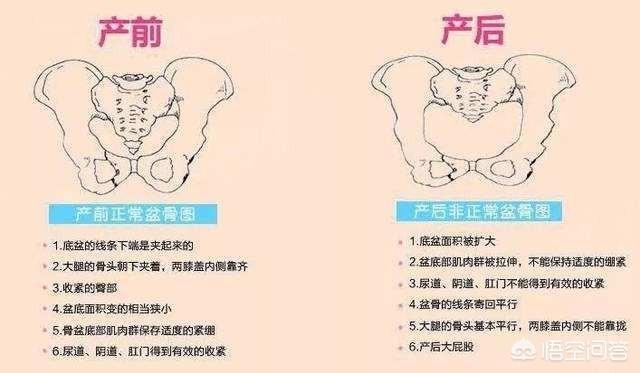 产后屁股不一样大怎么恢复？