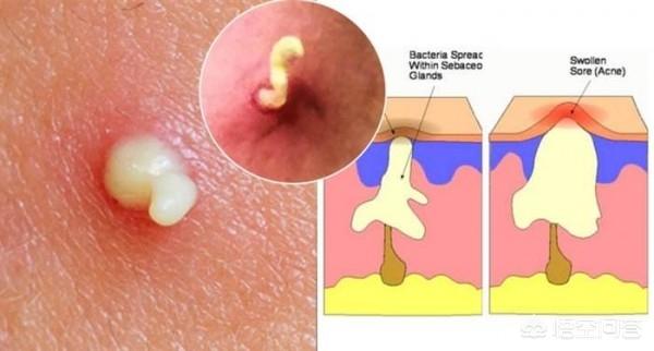 毛囊虫的原因是什么:毛囊虫是什么原因引起的 从痘痘里挤出来的白色液体是螨虫尸体吗？求大神指教？