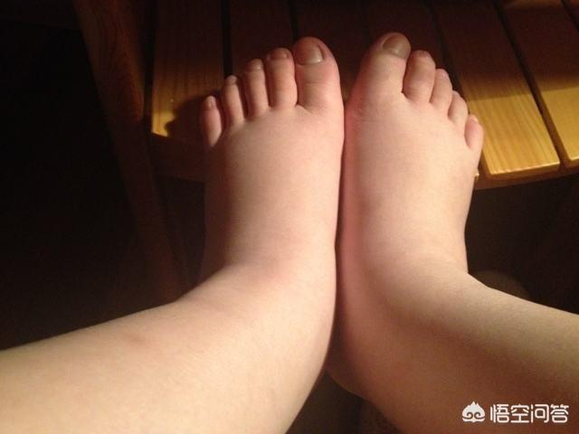 孕妇脚肿是什么原因:怀孕20周脚肿腿肿怎么办？