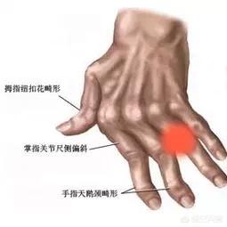 怎么增强自身免疫力抵抗类风湿性关节炎:类风湿性关节炎预防方法？