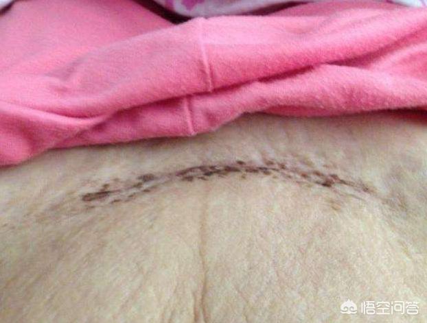 子宫恢复后,疤痕的正常厚度为3mm-5mm都正常.