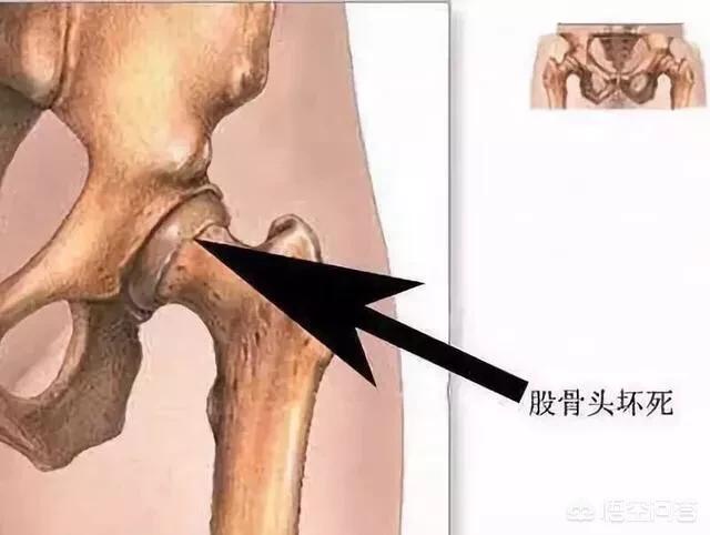 胯骨疼是怎么回事胯骨疼是怎么回事女性该吃什么药