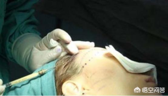 颞部填充,什么是自体脂肪丰太阳穴？